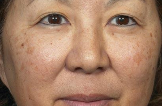 fraxel laser acne scars