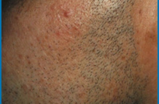 me laser hair removal before