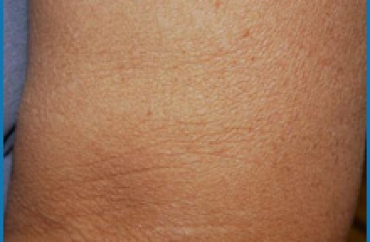 skin tightening laser treatment