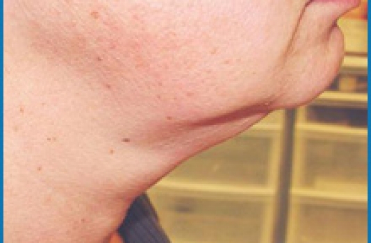 laser for skin tightening on face