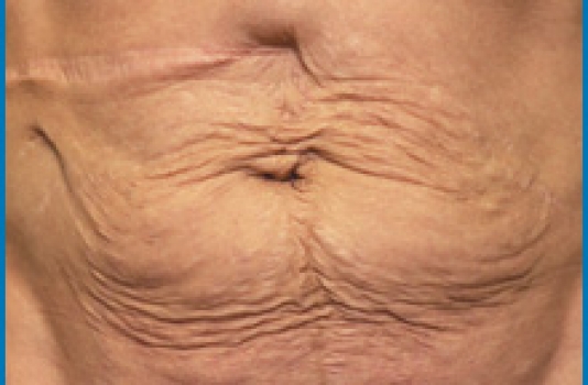 Laser surgery for skin tightening before