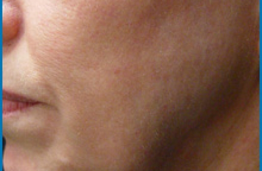 face skin tightening laser before