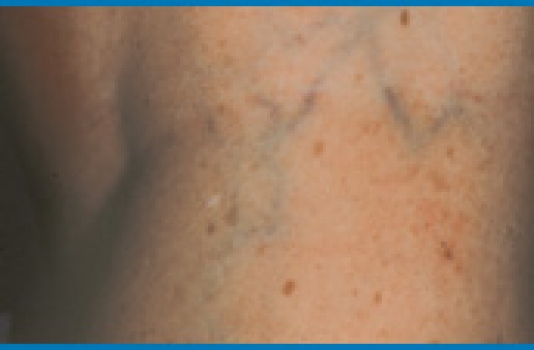 laser vein removal cost