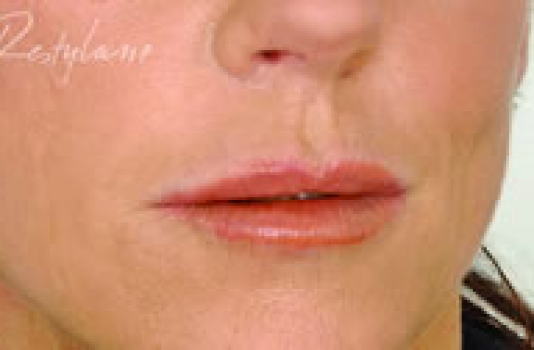 lip dermal fillers after