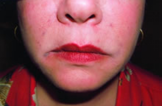 dermal fillers nose to mouth lines after