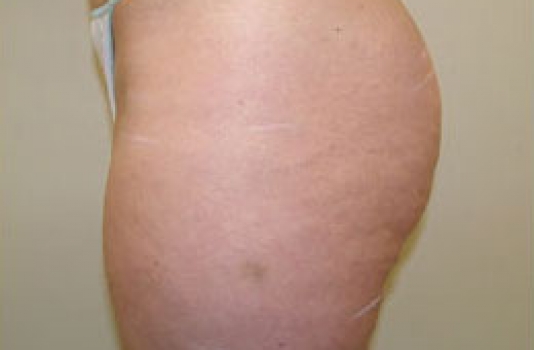 cellulite surgery before and after