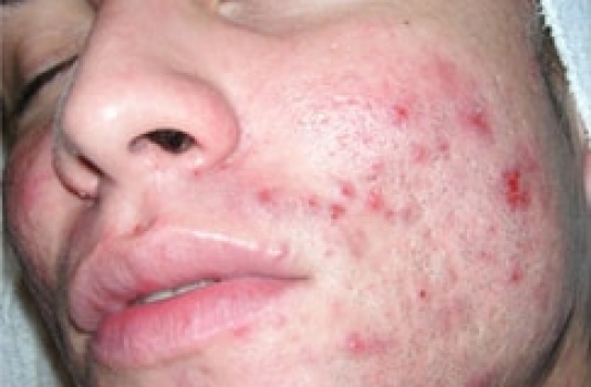 microdermabrasion for acne