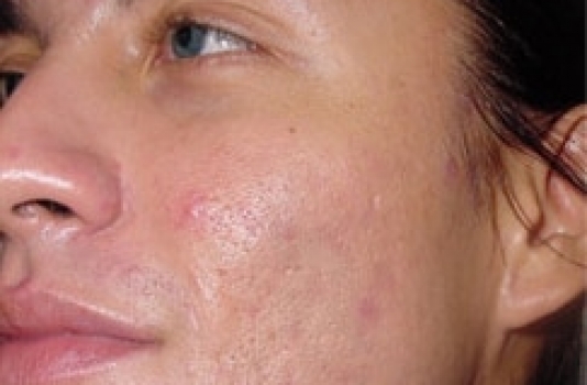 microdermabrasion after for acne