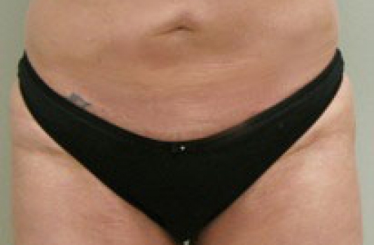 smart lipo abs after