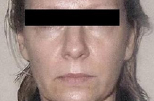 Titan Laser Before face and neck